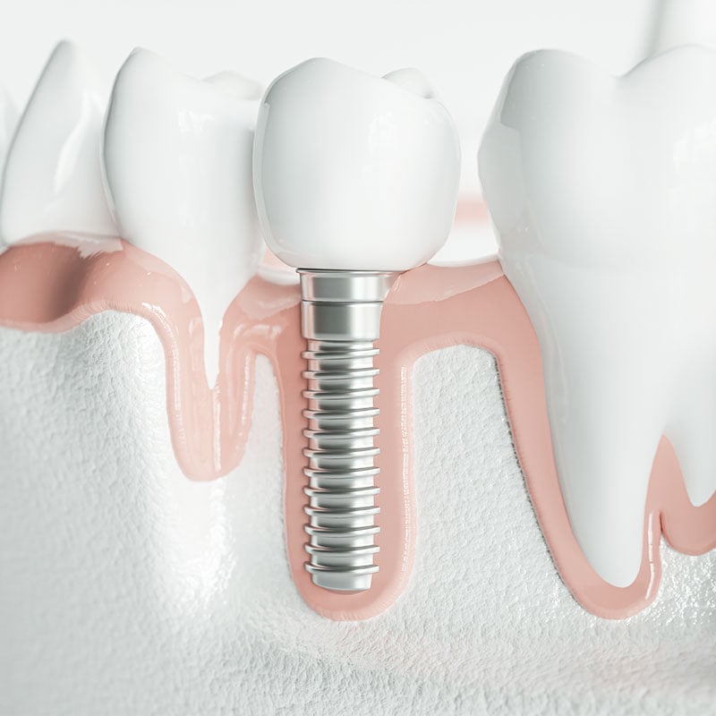 Dental Implants