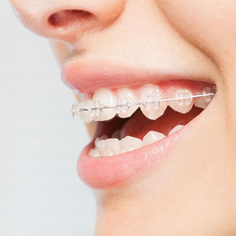 Orthodontic Treatment